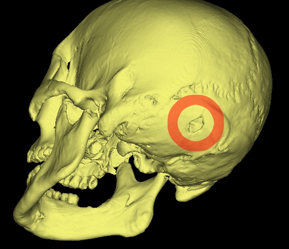 skull with bullethole